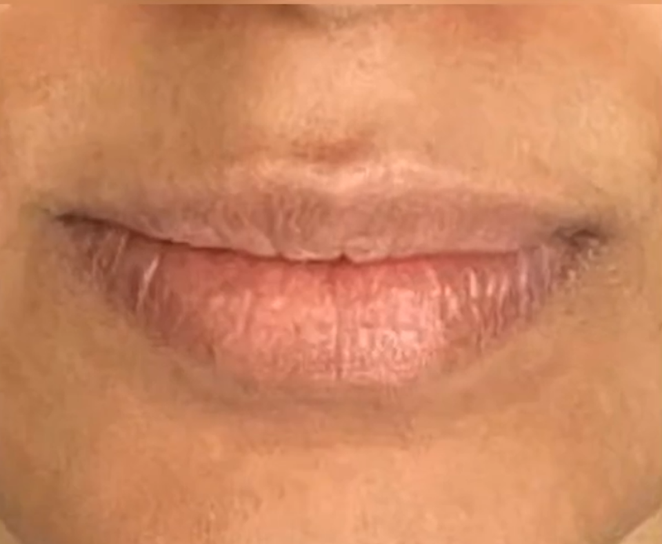 lips of the lady before the surgery